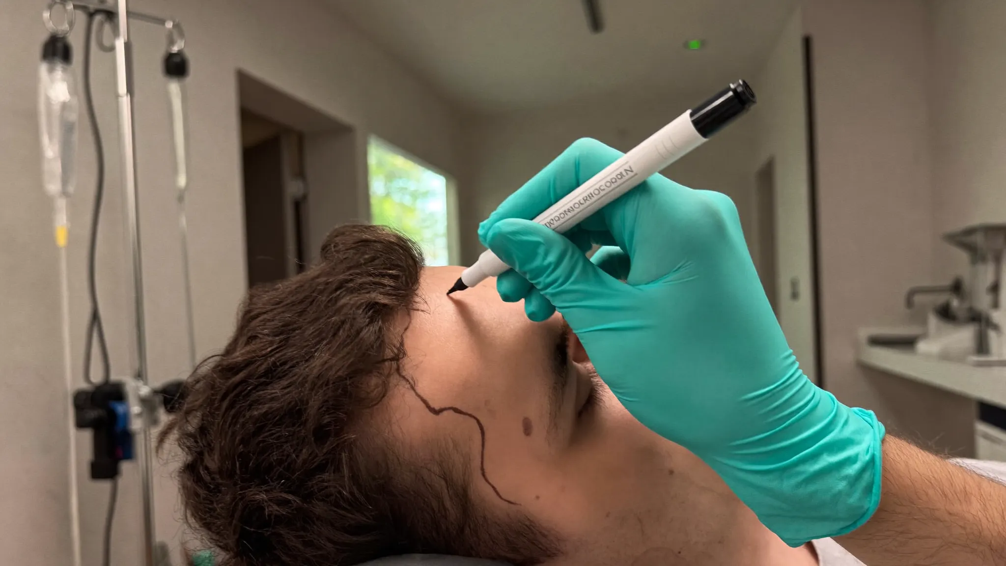 Analyse und Planung der Haarlinie bei Haarausfall bei Männern