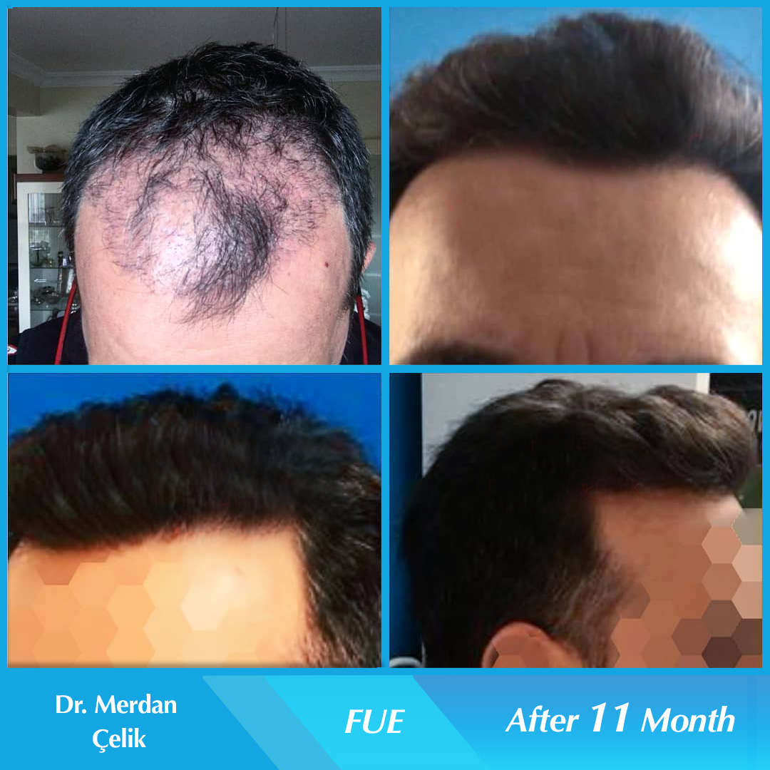 Haartransplantation mit ärztlicher Planung der Haarlinie und medizinischer Betreuung