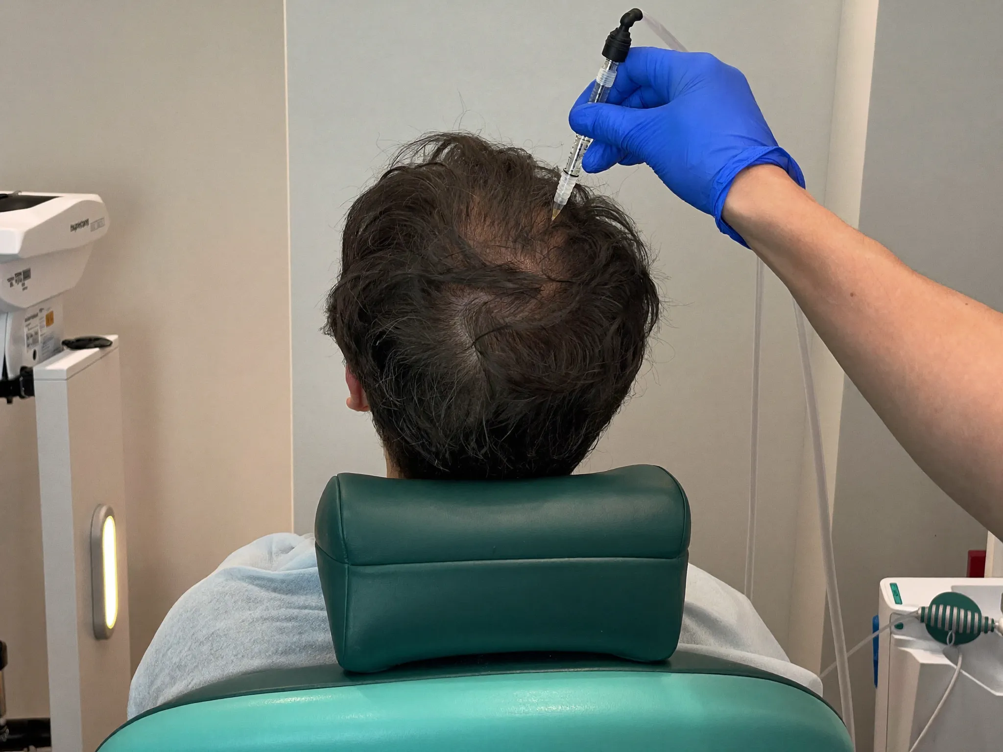 Mesotherapie bei Haarausfall in der Menopause